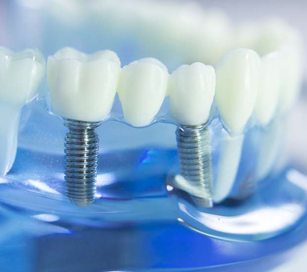 Temple Dental Implants