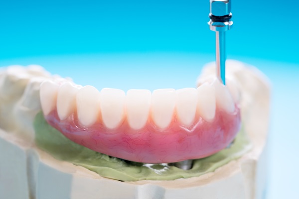 How Secure Are Implant Supported Dentures?